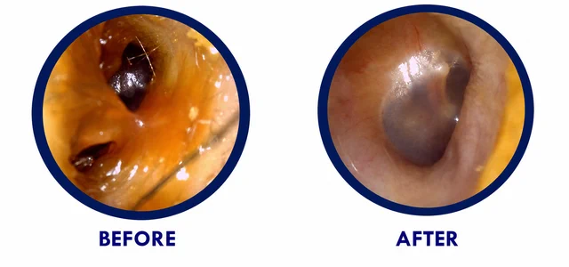 Side-by-side otoscope images labelled before and after earwax removal